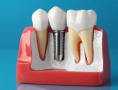 北京种植牙一颗多少钱