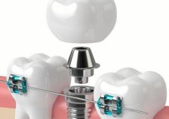 北京种植牙价格表种一颗牙多少钱