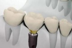 北京种牙多少钱一颗2024年