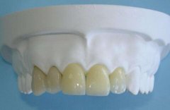 北京烤瓷牙多少钱一颗