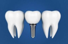 北京种植牙可以走医保报销吗