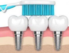 北京种牙可以走医保报销吗2024年