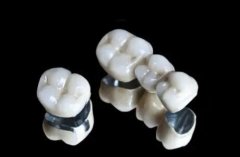 北京烤瓷牙可以走医保吗