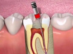 北京根管治疗报销比例