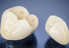 北京烤瓷牙医保报销吗