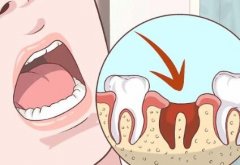 西安牙齿矫正大概多少钱？牙齿矫正原理/适用人群