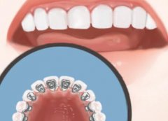 西安牙齿矫正价目表怎么样？附牙齿矫正好处分享/注意事项