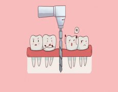 拨牙齿多久才种植牙呢？一般在三个月不等