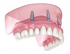 不种植牙怎么补大牙齿呢？可以通过安装可移动假牙等