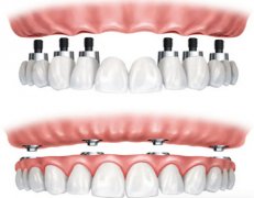 广州牙齿种植多少钱一颗？有舒适/稳固/美观等优点