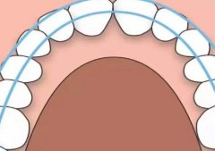 成都牙齿矫正大概多少钱？什么年龄段更合适？