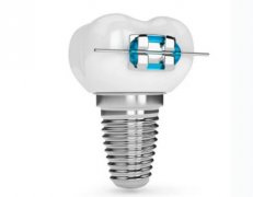 成都种牙要多少钱一颗？需要多长时间完成？