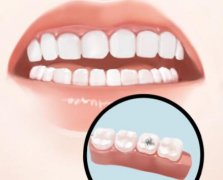 上海种植牙已纳入医保政策，没有正式