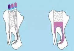 成都根管治疗价格是多少？参考价格公开