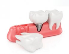 广州牙齿种植多少钱？牙齿种植完成时间科普