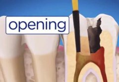 上海根管治疗进医保吗？包括注意事项分享