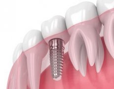 重庆牙齿种植的好处有哪些？操作流程分享