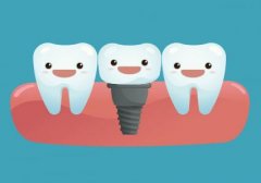 广州种植牙多少钱一颗2024年？种植牙存在风险一览