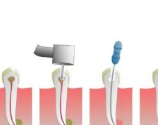 广州根管治疗多少钱一颗牙？流程是怎么样的