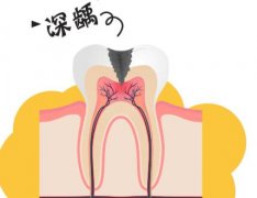 广州根管治疗收费标准，管治疗需要多长时间?