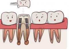 根管治疗的牙齿就是死牙了吗？不等于死牙/附根管治疗科普