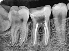 根管治疗的牙齿酸胀痛怎么缓解？可冷敷/借助药物/调整饮食