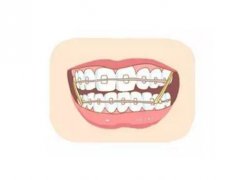 郑州牙齿矫正需要多少钱？一般一万元起步，与矫正材料/选择医院有关