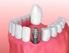 西安种植牙多少钱一颗2024年？内附注意事项及种植牙维护方法