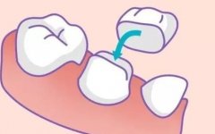 杭州烤瓷牙一般多少钱？内附烤瓷牙手术注意事项