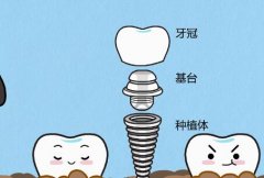 深圳牙齿种植要多长时间？术后清淡饮食恢复快