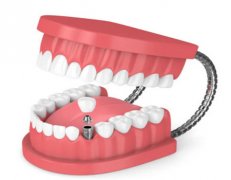 深圳牙齿种植修复需要多少钱？一般5千元起步，与使用材料/医院有关