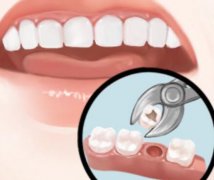 杭州牙齿种植现在降价了吗？牙齿种植能用多久？