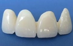 上海烤瓷牙进医保了？并不在医保报销的范畴之内