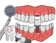 杭州种植牙多少钱一颗牙？选择大型公立医院收费公开透明