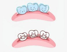 根管治疗后保护牙齿的方法有哪些？附根管治疗牙齿条件分析