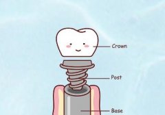 长沙牙齿种植牙手术多少钱？与种植体的材质/牙齿情况有关