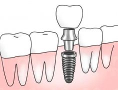 长沙种植牙价格贵不贵？具有波动性/费用与牙齿材质有关