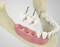 昆明种植牙多少钱一颗2024年？种植牙价格浮动大