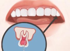 根管治疗后的牙齿能用多久？附根管断针的风险及后续处理