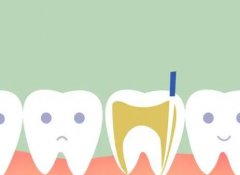 根管治疗后的牙齿要恢复多久？一般是需要1到2周的时间