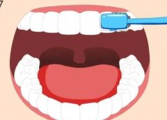 根管治疗后什么时候可以补牙齿？ 需要半个月到一个月可以补牙