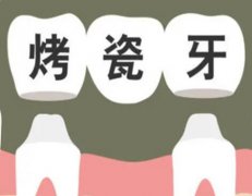 东莞烤瓷牙价格表，镍铬合金烤瓷牙，价格大概在400元起一颗