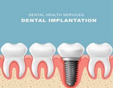 南京种植牙一颗多少钱