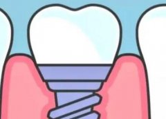 沈阳根管治疗费用大概多少？不同医院费用不同