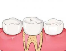 长沙根管治疗哪里便宜？附根管治疗注意事项