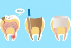 长沙根管治疗费用贵不贵?与牙齿病变程度息息相关