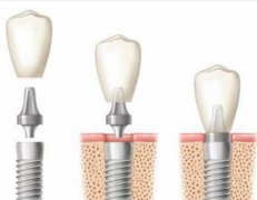 昆明牙齿种植技术怎么样？普遍采用国际先进的技术