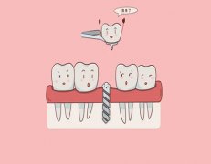 沈阳种牙价格一般多少钱