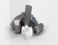 沈阳种植牙价格