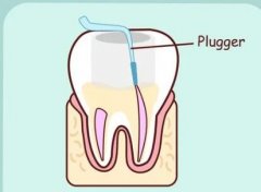 天津根管治疗费用